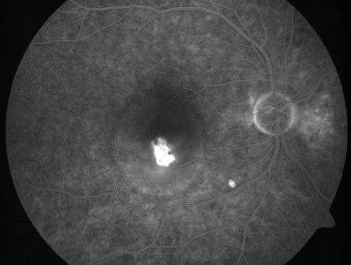 Acute Central Serous Retinopathy (Chorioretinopathy) Right Eye
45-year-old man decreased vision in the right eye starting about two days ago.  VISUAL ACUITY:  Vision OD is 20/60, OS is 20/20.  
