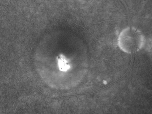 Acute Central Serous Retinopathy (Chorioretinopathy) Right Eye
45-year-old man decreased vision in the right eye starting about two days ago.  VISUAL ACUITY:  Vision OD is 20/60, OS is 20/20.  
