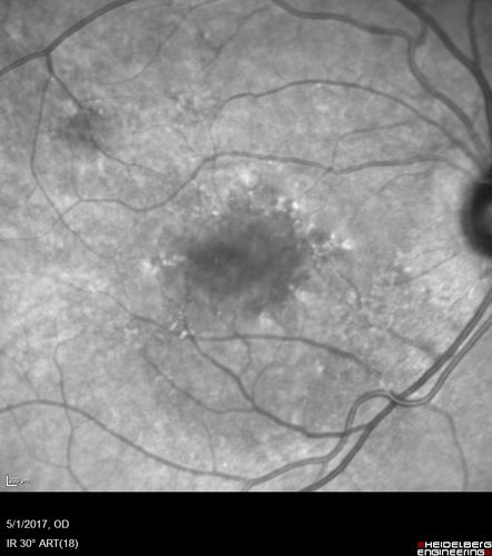 Central Serous Retinopathy - Subretinal Fibrin
66 year old female with 20 year history of single episode of CSR.  Now with vision loss for a month but improving - VA 20/63 OD; 20/32 OS
