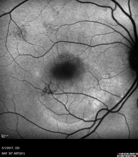 Central Serous Retinopathy - Subretinal Fibrin
66 year old female with 20 year history of single episode of CSR.  Now with vision loss for a month but improving - VA 20/63 OD; 20/32 OS
