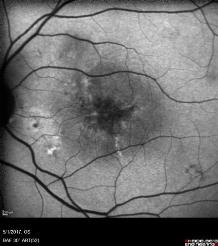 Central Serous Retinopathy - Subretinal Fibrin
66 year old female with 20 year history of single episode of CSR.  Now with vision loss for a month but improving - VA 20/63 OD; 20/32 OS
