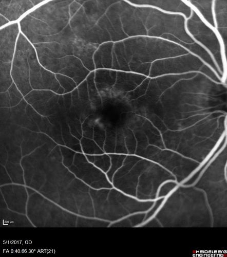 Central Serous Retinopathy - Subretinal Fibrin
66 year old female with 20 year history of single episode of CSR.  Now with vision loss for a month but improving - VA 20/63 OD; 20/32 OS
