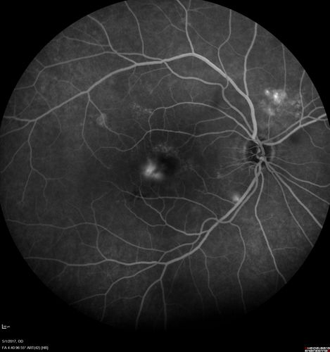 Central Serous Retinopathy - Subretinal Fibrin
66 year old female with 20 year history of single episode of CSR.  Now with vision loss for a month but improving - VA 20/63 OD; 20/32 OS
