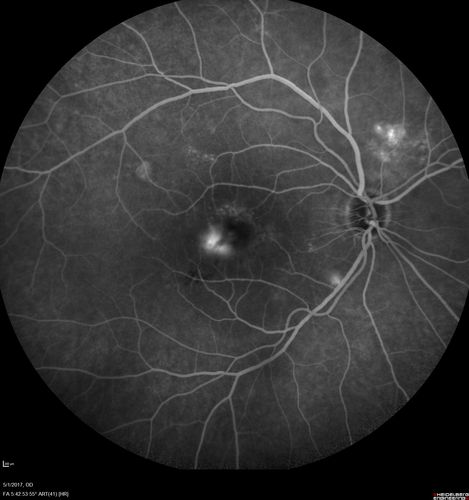 Central Serous Retinopathy - Subretinal Fibrin
66 year old female with 20 year history of single episode of CSR.  Now with vision loss for a month but improving - VA 20/63 OD; 20/32 OS
