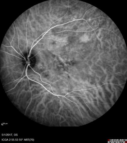 Central Serous Retinopathy - Subretinal Fibrin
66 year old female with 20 year history of single episode of CSR.  Now with vision loss for a month but improving - VA 20/63 OD; 20/32 OS
