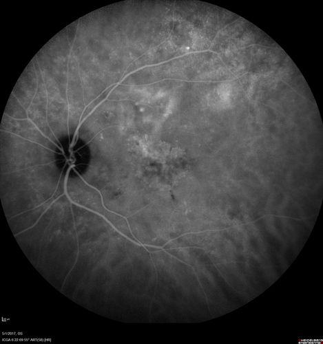Central Serous Retinopathy - Subretinal Fibrin
66 year old female with 20 year history of single episode of CSR.  Now with vision loss for a month but improving - VA 20/63 OD; 20/32 OS
