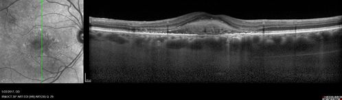 Central Serous Retinopathy - Subretinal Fibrin
66 year old female with 20 year history of single episode of CSR.  Now with vision loss for a month but improving - VA 20/63 OD; 20/32 OS
