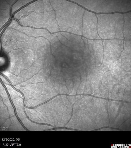 Central Serous Chorioretinopathy - Expanding hot spot - photodynamic laser
35 year old man with acute central serous chorioretinopathy.  The fluid got better then worse and the patient was treated with full strength juxtafoveal PDT and then got better.

