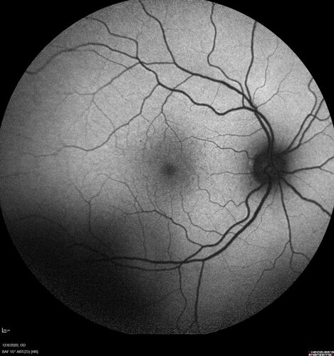 Central Serous Chorioretinopathy - Expanding hot spot - photodynamic laser
35 year old man with acute central serous chorioretinopathy.  The fluid got better then worse and the patient was treated with full strength juxtafoveal PDT and then got better.
