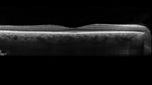 Central Serous Chorioretinopathy - Expanding hot spot - photodynamic laser
35 year old man with acute central serous chorioretinopathy.  The fluid got better then worse and the patient was treated with full strength juxtafoveal PDT and then got better.
