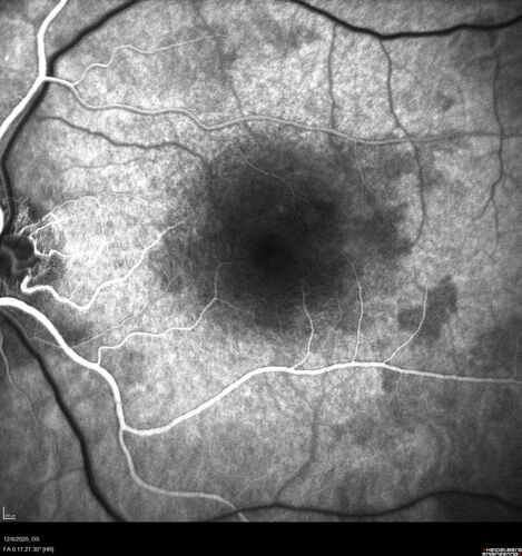 Central Serous Chorioretinopathy - Expanding hot spot - photodynamic laser
35 year old man with acute central serous chorioretinopathy.  The fluid got better then worse and the patient was treated with full strength juxtafoveal PDT and then got better.
