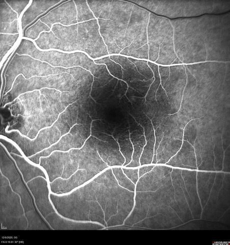 Central Serous Chorioretinopathy - Expanding hot spot - photodynamic laser
35 year old man with acute central serous chorioretinopathy.  The fluid got better then worse and the patient was treated with full strength juxtafoveal PDT and then got better.
