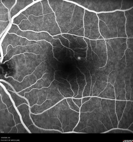 Central Serous Chorioretinopathy - Expanding hot spot - photodynamic laser
35 year old man with acute central serous chorioretinopathy.  The fluid got better then worse and the patient was treated with full strength juxtafoveal PDT and then got better.
