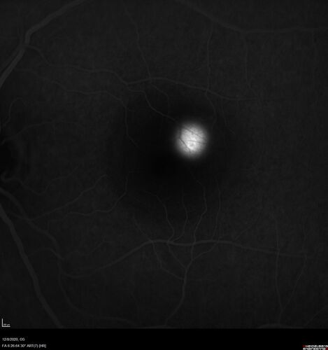 Central Serous Chorioretinopathy - Expanding hot spot - photodynamic laser
35 year old man with acute central serous chorioretinopathy.  The fluid got better then worse and the patient was treated with full strength juxtafoveal PDT and then got better.
