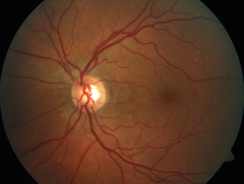 Chronic CSR with mild vision loss - Macular Atrophy Right Eye
55 year old man has not been to an eye doctor in years.  VA 20/40 OD and 20/25 OS.  OCT shows outer retinal atrophy and choroidal thickening.  FAF shows guttering.  FA shows no active lesions.  ICG shows patchy mild leakage visible at about 5 minutes.
