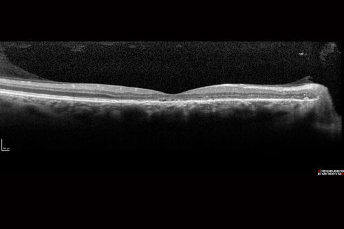 Chronic CSR with mild vision loss - Macular Atrophy Right Eye
55 year old man has not been to an eye doctor in years.  VA 20/40 OD and 20/25 OS.  OCT shows outer retinal atrophy and choroidal thickening.  FAF shows guttering.  FA shows no active lesions.  ICG shows patchy mild leakage visible at about 5 minutes.
