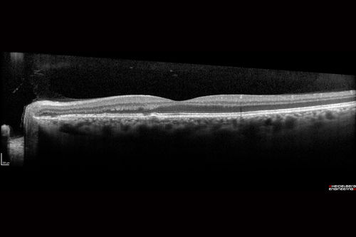 Chronic CSR with mild vision loss - Macular Atrophy Right Eye
55 year old man has not been to an eye doctor in years.  VA 20/40 OD and 20/25 OS.  OCT shows outer retinal atrophy and choroidal thickening.  FAF shows guttering.  FA shows no active lesions.  ICG shows patchy mild leakage visible at about 5 minutes.
