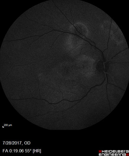 Chronic CSR with mild vision loss - Macular Atrophy Right Eye
55 year old man has not been to an eye doctor in years.  VA 20/40 OD and 20/25 OS.  OCT shows outer retinal atrophy and choroidal thickening.  FAF shows guttering.  FA shows no active lesions.  ICG shows patchy mild leakage visible at about 5 minutes.
