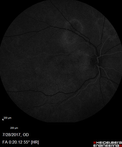 Chronic CSR with mild vision loss - Macular Atrophy Right Eye
55 year old man has not been to an eye doctor in years.  VA 20/40 OD and 20/25 OS.  OCT shows outer retinal atrophy and choroidal thickening.  FAF shows guttering.  FA shows no active lesions.  ICG shows patchy mild leakage visible at about 5 minutes.
