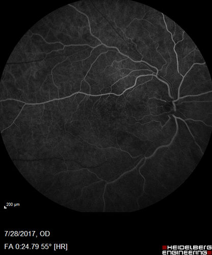 Chronic CSR with mild vision loss - Macular Atrophy Right Eye
55 year old man has not been to an eye doctor in years.  VA 20/40 OD and 20/25 OS.  OCT shows outer retinal atrophy and choroidal thickening.  FAF shows guttering.  FA shows no active lesions.  ICG shows patchy mild leakage visible at about 5 minutes.
