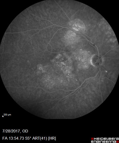 Chronic CSR with mild vision loss - Macular Atrophy Right Eye
55 year old man has not been to an eye doctor in years.  VA 20/40 OD and 20/25 OS.  OCT shows outer retinal atrophy and choroidal thickening.  FAF shows guttering.  FA shows no active lesions.  ICG shows patchy mild leakage visible at about 5 minutes.

