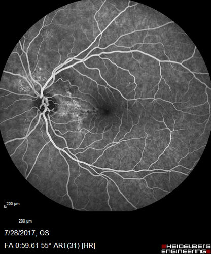 Chronic CSR with mild vision loss - Macular Atrophy Right Eye
55 year old man has not been to an eye doctor in years.  VA 20/40 OD and 20/25 OS.  OCT shows outer retinal atrophy and choroidal thickening.  FAF shows guttering.  FA shows no active lesions.  ICG shows patchy mild leakage visible at about 5 minutes.
