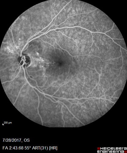 Chronic CSR with mild vision loss - Macular Atrophy Right Eye
55 year old man has not been to an eye doctor in years.  VA 20/40 OD and 20/25 OS.  OCT shows outer retinal atrophy and choroidal thickening.  FAF shows guttering.  FA shows no active lesions.  ICG shows patchy mild leakage visible at about 5 minutes.
