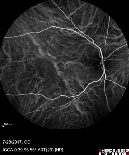 Chronic CSR with mild vision loss - Macular Atrophy Right Eye
55 year old man has not been to an eye doctor in years.  VA 20/40 OD and 20/25 OS.  OCT shows outer retinal atrophy and choroidal thickening.  FAF shows guttering.  FA shows no active lesions.  ICG shows patchy mild leakage visible at about 5 minutes.
