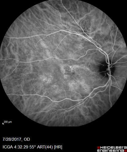 Chronic CSR with mild vision loss - Macular Atrophy Right Eye
55 year old man has not been to an eye doctor in years.  VA 20/40 OD and 20/25 OS.  OCT shows outer retinal atrophy and choroidal thickening.  FAF shows guttering.  FA shows no active lesions.  ICG shows patchy mild leakage visible at about 5 minutes.
