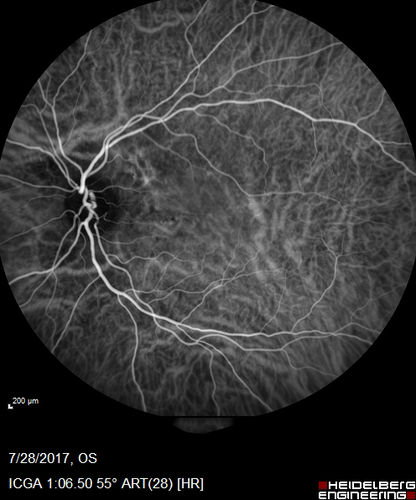 Chronic CSR with mild vision loss - Macular Atrophy Right Eye
55 year old man has not been to an eye doctor in years.  VA 20/40 OD and 20/25 OS.  OCT shows outer retinal atrophy and choroidal thickening.  FAF shows guttering.  FA shows no active lesions.  ICG shows patchy mild leakage visible at about 5 minutes.
