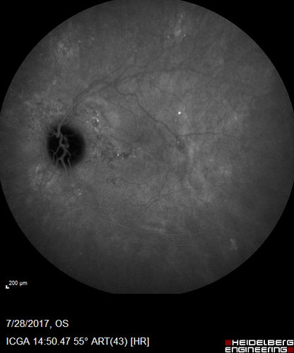 Chronic CSR with mild vision loss - Macular Atrophy Right Eye
55 year old man has not been to an eye doctor in years.  VA 20/40 OD and 20/25 OS.  OCT shows outer retinal atrophy and choroidal thickening.  FAF shows guttering.  FA shows no active lesions.  ICG shows patchy mild leakage visible at about 5 minutes.
