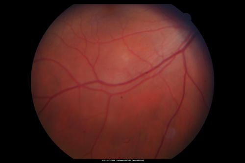 Idiopathic Central Serous Retinopathy - Bilateral - Acute 
49-year-old man  decreasing vision in the left eye for one week.  He is not taking any steroid or steroid-related products.  His blood pressure as far as he knows is under control.

VISUAL ACUITY:  OD 20/30, OS 20/400
