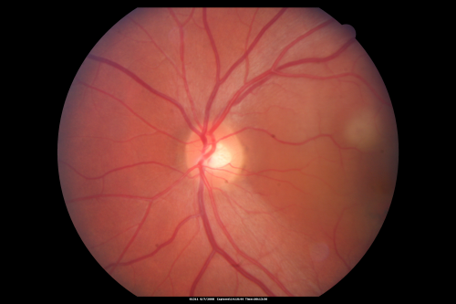 Idiopathic Central Serous Retinopathy - Bilateral - Acute 
49-year-old man  decreasing vision in the left eye for one week.  He is not taking any steroid or steroid-related products.  His blood pressure as far as he knows is under control.

VISUAL ACUITY:  OD 20/30, OS 20/400

