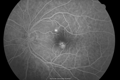 Idiopathic Central Serous Retinopathy - Bilateral - Acute 
49-year-old man  decreasing vision in the left eye for one week.  He is not taking any steroid or steroid-related products.  His blood pressure as far as he knows is under control.

VISUAL ACUITY:  OD 20/30, OS 20/400

