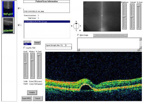 Idiopathic Central Serous Retinopathy - Bilateral - Acute 4 months later VA 20/40 OU
No treatment and fluid under fovea in left eye is competely absorbed at 4 months.

