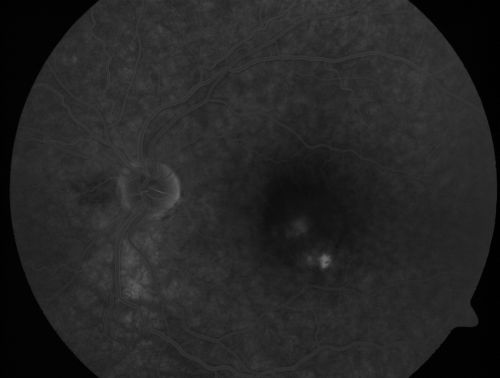 Chronic Central Serous Retinopathy treated with Photodynamic Laser and Visudyne
48-year-old man has had waxing and waning vision in the left eye for the last year from central serous retinopathy. OD is 20/16, OS is 20/30.
