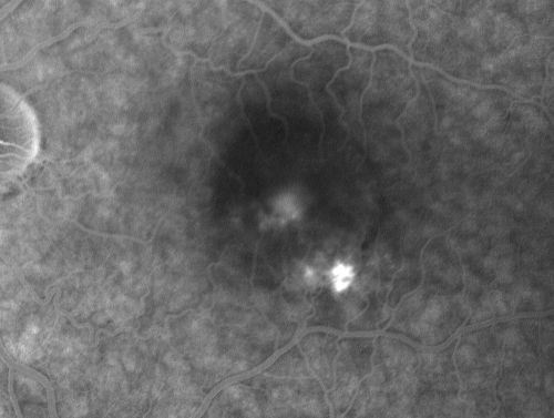 Chronic Central Serous Retinopathy treated with Photodynamic Laser and Visudyne
48-year-old man has had waxing and waning vision in the left eye for the last year from central serous retinopathy. OD is 20/16, OS is 20/30.
