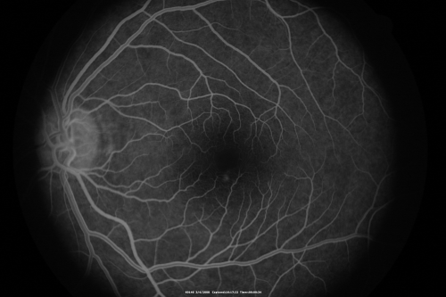 Central Serous Retinopathy
Later  FA
Keywords: Central Serous Retinopathy