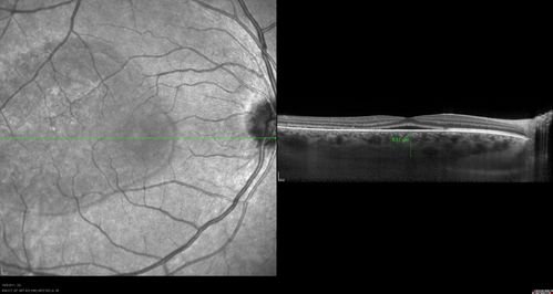 42-year-old man was seen in the office on October 5, 2011.  He had noticed starting in August after a course of antibiotic and steroids, that he developed new spots in his vision in the right eye.  He may have had an episode like this sometime in the past.  He did take steroids a few years ago and his vision did change at that time, but then returned.  

VISUAL ACUITY:  OD 20/32,  OS 20/32.  The OCT scan of the right eye confirms subretinal fluid.
