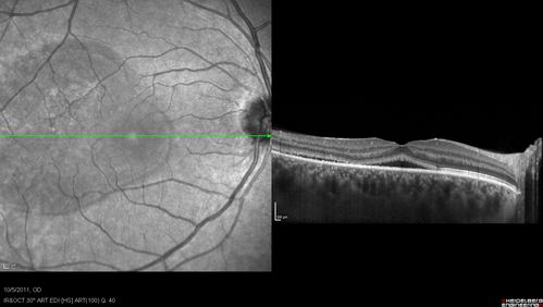 42-year-old man was seen in the office on October 5, 2011.  He had noticed starting in August after a course of antibiotic and steroids, that he developed new spots in his vision in the right eye.  He may have had an episode like this sometime in the past.  He did take steroids a few years ago and his vision did change at that time, but then returned.  

VISUAL ACUITY:  OD 20/32,  OS 20/32.  The OCT scan of the right eye confirms subretinal fluid.
