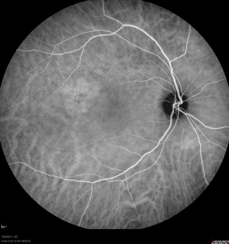 Acute Central Serous Retinopathy - CSR - Steroid Induced (probably) - Good Vision - ICG Affected Eye - Choroidal Leakage
42-year-old man was seen in the office on October 5, 2011.  He had noticed starting in August after a course of antibiotic and steroids, that he developed new spots in his vision in the right eye.  He may have had an episode like this sometime in the past.  He did take steroids a few years ago and his vision did change at that time, but then returned.  

VISUAL ACUITY:  OD 20/32,  OS 20/32.  The OCT scan of the right eye confirms subretinal fluid.
