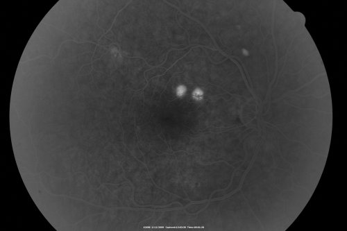Acute Central Serous Chorioretinopathy with Symptoms in Hazy Vision Both Eyes
48-year-old man with hazy vision in the right eye for about three days.  He has a little more of a headache than usual.  He is under a fair amount of stress.  He does not take any steroids that he knows of.  He does use a nasal spray, which he is not sure if that is a steroid spray or not.  He is going to call us with that medicine.  I checked his blood pressure today is was 115/95.   

VISUAL ACUITY:  OD 20/15, OS 20/25
