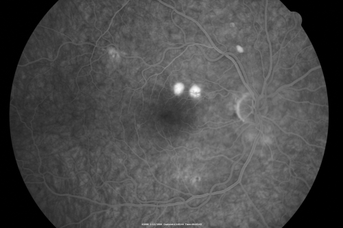 Acute Central Serous Chorioretinopathy with Symptoms in Hazy Vision Both Eyes

