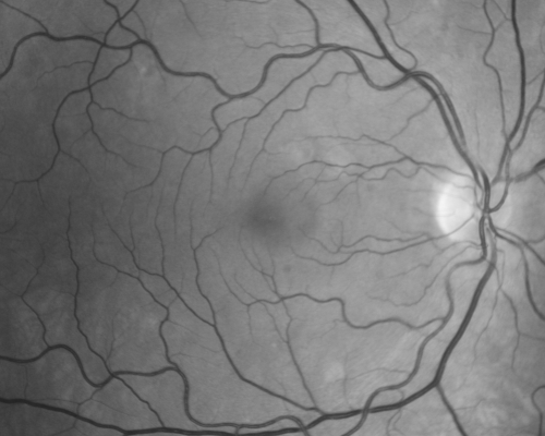 Acute Central Serous Chorioretinopathy with Symptoms in Hazy Vision Both Eyes
48-year-old man with hazy vision in the right eye for about three days.  He has a little more of a headache than usual.  He is under a fair amount of stress.  He does not take any steroids that he knows of.  He does use a nasal spray, which he is not sure if that is a steroid spray or not.  He is going to call us with that medicine.  I checked his blood pressure today is was 115/95.   

VISUAL ACUITY:  OD 20/15, OS 20/25
