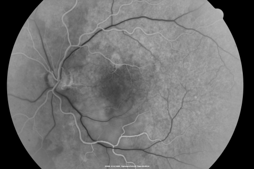 Acute Central Serous Chorioretinopathy with Symptoms in Hazy Vision Both Eyes
48-year-old man with hazy vision in the right eye for about three days.  He has a little more of a headache than usual.  He is under a fair amount of stress.  He does not take any steroids that he knows of.  He does use a nasal spray, which he is not sure if that is a steroid spray or not.  He is going to call us with that medicine.  I checked his blood pressure today is was 115/95.   

VISUAL ACUITY:  OD 20/15, OS 20/25
