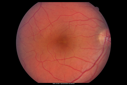 Acute Central Serous Retinopathy - CSR - Steroid Induced (probably) - Good Vision - 6 months later - vision Better - Normal Photo
42-year-old man has central serous retinopathy in the right eye with serous retinal detachment. 6 month follow-up Vision is better.

VISUAL ACUITY:  OD 20/20. 

