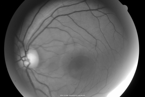 Central Serous Retinopathy
Red Free photo
Keywords: Central Serous Retinopathy