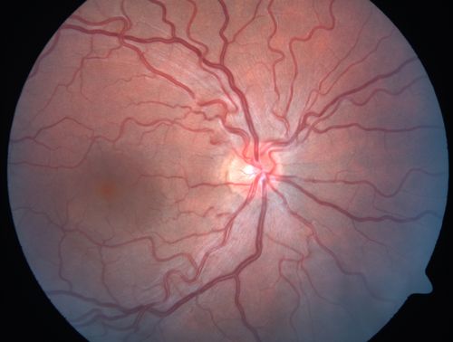 Acute Central Serous Retinopathy - Classic Smokestack on Fluorescein Angiogram 
34-year-old man noticed about five days ago decreased vision in the right eye.  He was having difficulty playing video games and seeing with that eye.  He thought maybe his refractive error was shifting.  
VISUAL ACUITY:  Vision OD is 20/40, OS is 20/16
