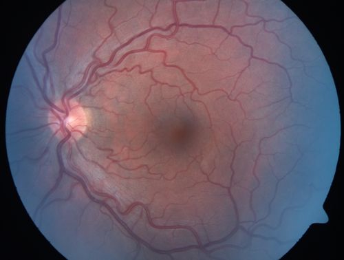 Acute Central Serous Retinopathy - Classic Smokestack on Fluorescein Angiogram 
34-year-old man noticed about five days ago decreased vision in the right eye.  He was having difficulty playing video games and seeing with that eye.  He thought maybe his refractive error was shifting.  
VISUAL ACUITY:  Vision OD is 20/40, OS is 20/16
