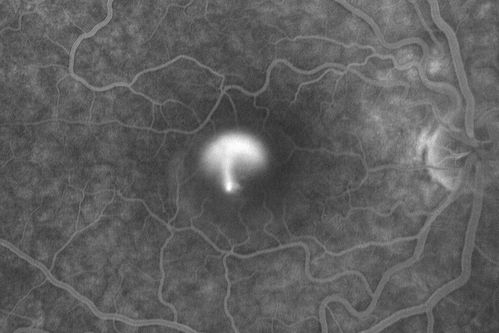 Acute Central Serous Retinopathy - Classic Smokestack on Fluorescein Angiogram 
34-year-old man noticed about five days ago decreased vision in the right eye.  He was having difficulty playing video games and seeing with that eye.  He thought maybe his refractive error was shifting.  
VISUAL ACUITY:  Vision OD is 20/40, OS is 20/16
